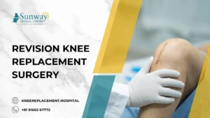 Revision Knee Replacement Surgery