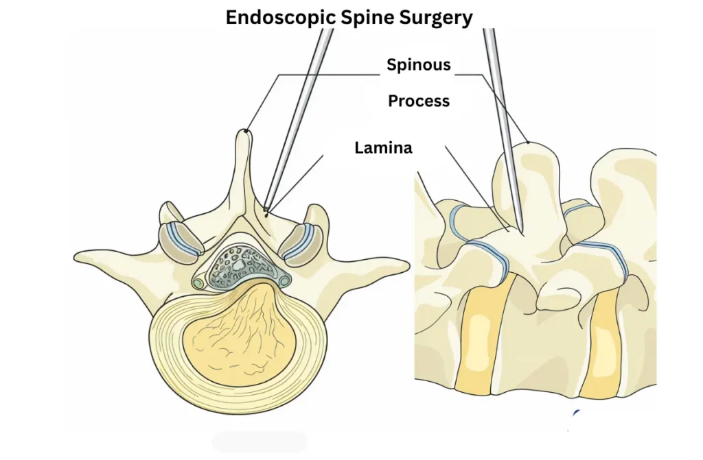 Endoscopic Spine Surgery Cost in Chennai 1 Endoscopic Spine Surgery Cost in Chennai