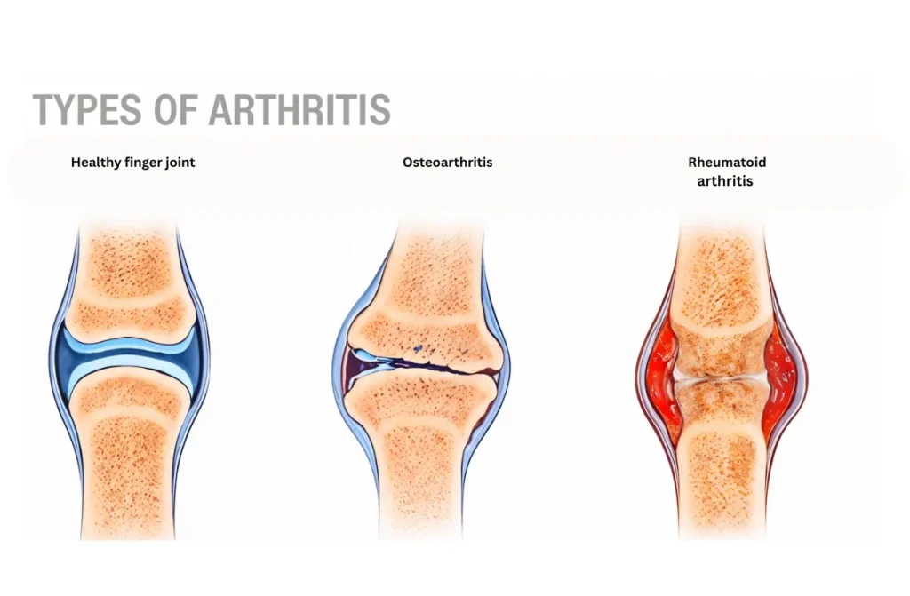 Rheumatoid Arthritis Specialist in Chennai 1 Rheumatoid Arthritis Specialist in Chennai