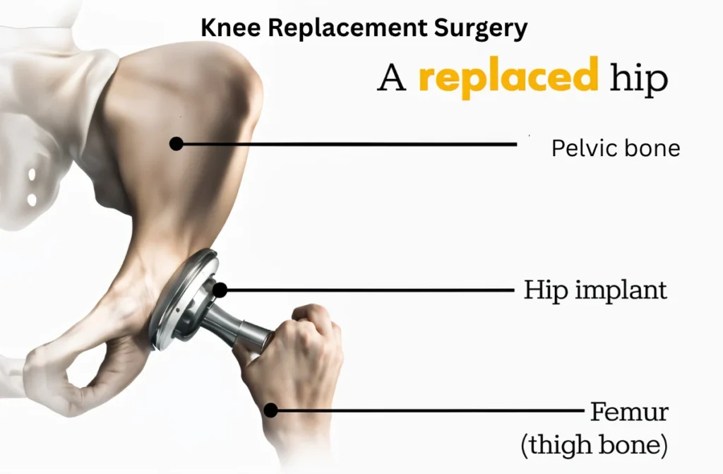Best Knee Replacement Hospital in Chennai 1 Best Knee Replacement Hospital in Chennai