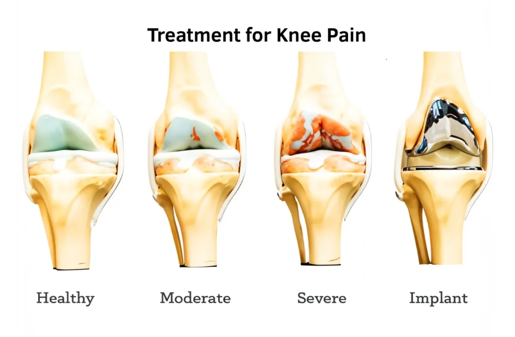 Best Treatment for Knee Pain 1 Best Treatment for Knee Pain