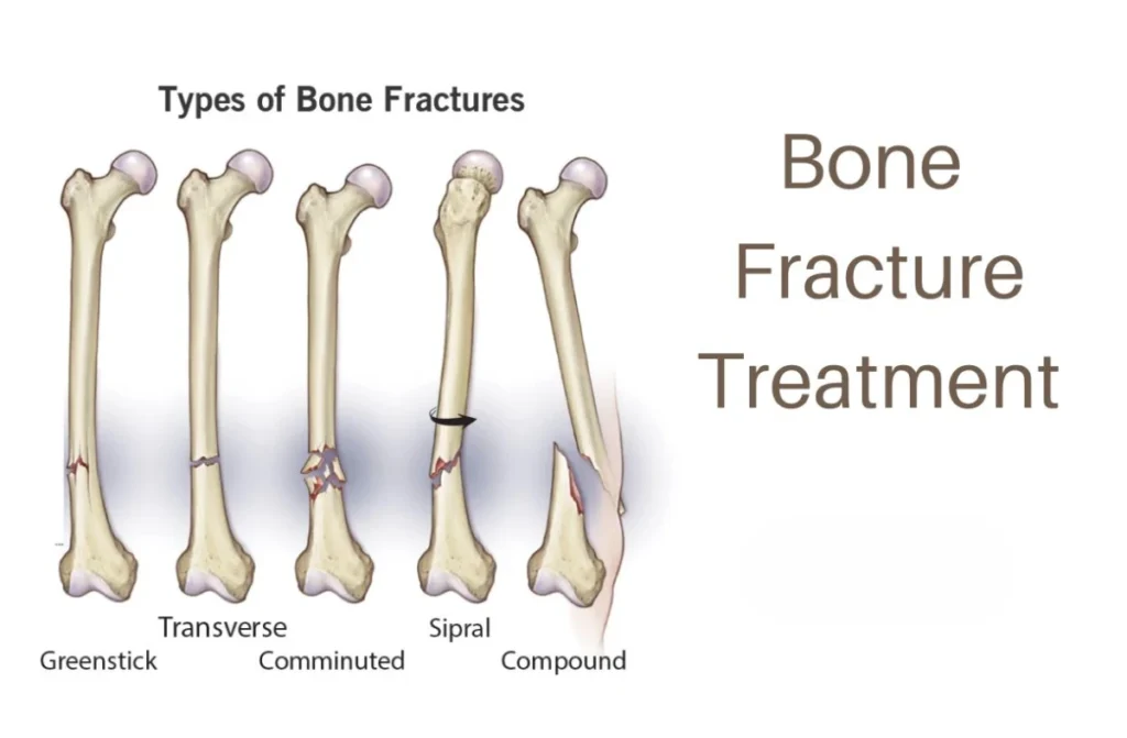 Fracture Treatment in Chennai 1 Fracture Treatment in Chennai