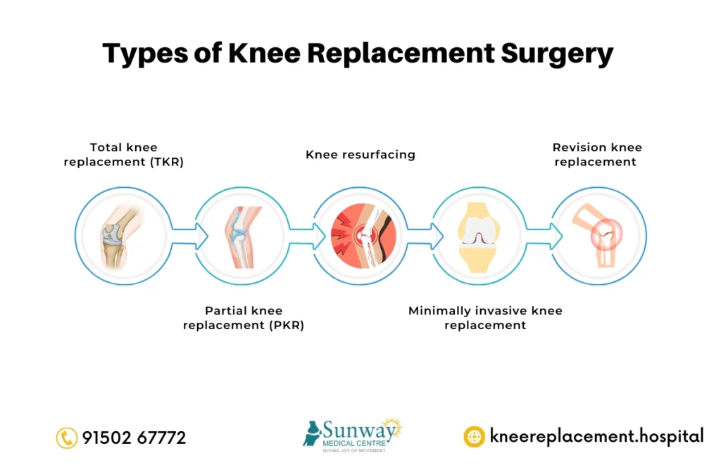 Types of Knee Replacement Surgery 1 Types of Knee Replacement Surgery