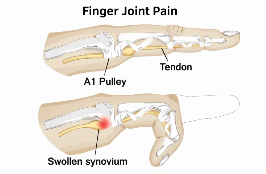 How to Relieve Finger Joint Pain 1 How to Relieve Finger Joint Pain