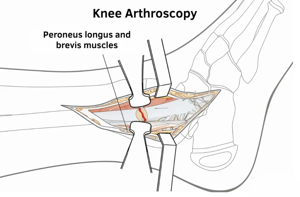 Knee Arthroscopy Recovery Time 1 Knee Arthroscopy Recovery Time