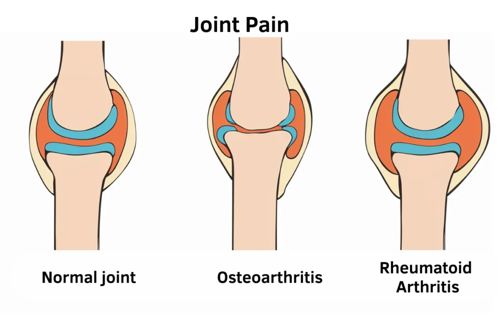 Treatment for Joint Pain 1 Treatment for Joint Pain