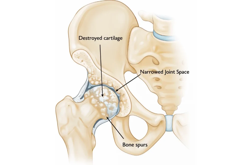 Hip Replacement Surgery in Chennai 1 Hip Replacement Surgery in Chennai
