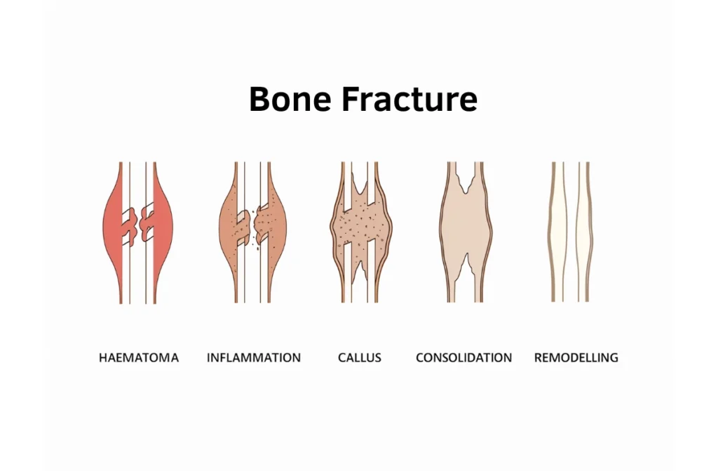 How to Heal Bone Fracture Fast 1 How to Heal Bone Fracture Fast