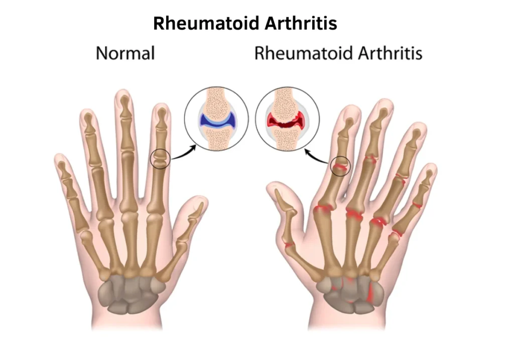 Early Signs of Rheumatoid Arthritis 1 Early Signs of Rheumatoid Arthritis