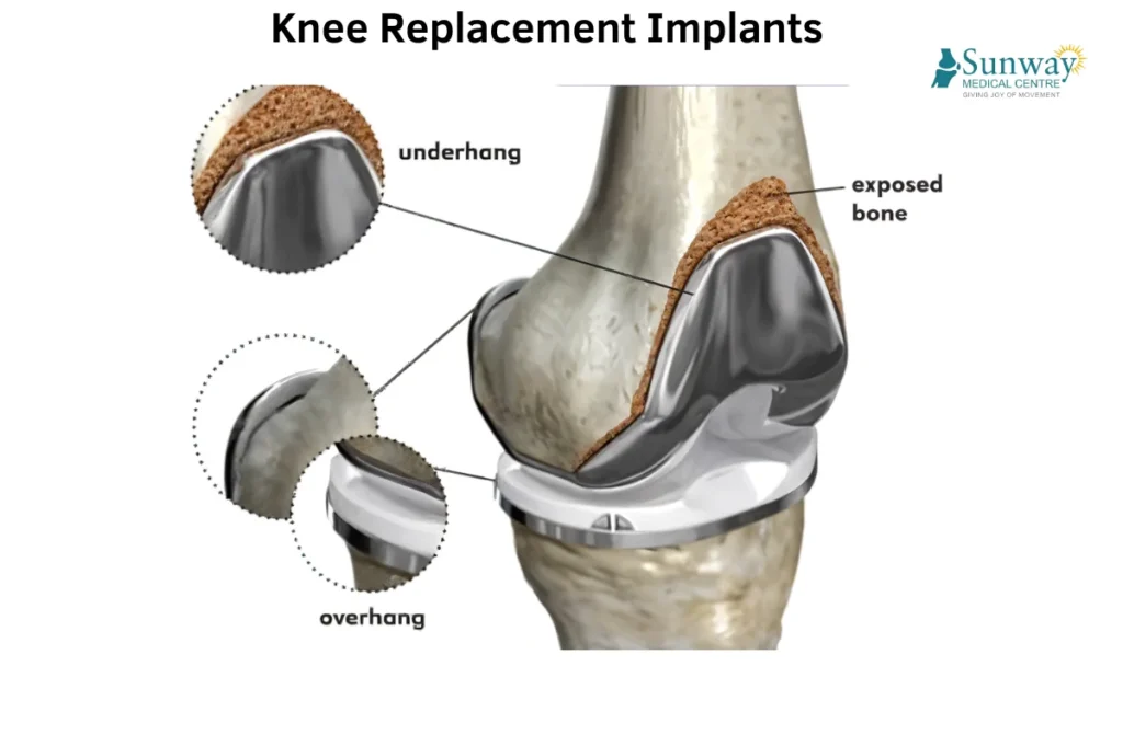 Knee Replacement Implants 1 Knee Replacement Implants